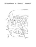 CRYOADHESIVE DEVICE FOR LEFT ATRIAL APPENDAGE OCCLUSION diagram and image