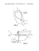 CRYOADHESIVE DEVICE FOR LEFT ATRIAL APPENDAGE OCCLUSION diagram and image