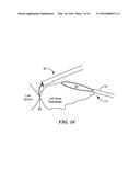 CRYOADHESIVE DEVICE FOR LEFT ATRIAL APPENDAGE OCCLUSION diagram and image