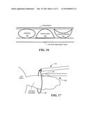 CRYOADHESIVE DEVICE FOR LEFT ATRIAL APPENDAGE OCCLUSION diagram and image