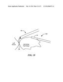 CRYOADHESIVE DEVICE FOR LEFT ATRIAL APPENDAGE OCCLUSION diagram and image