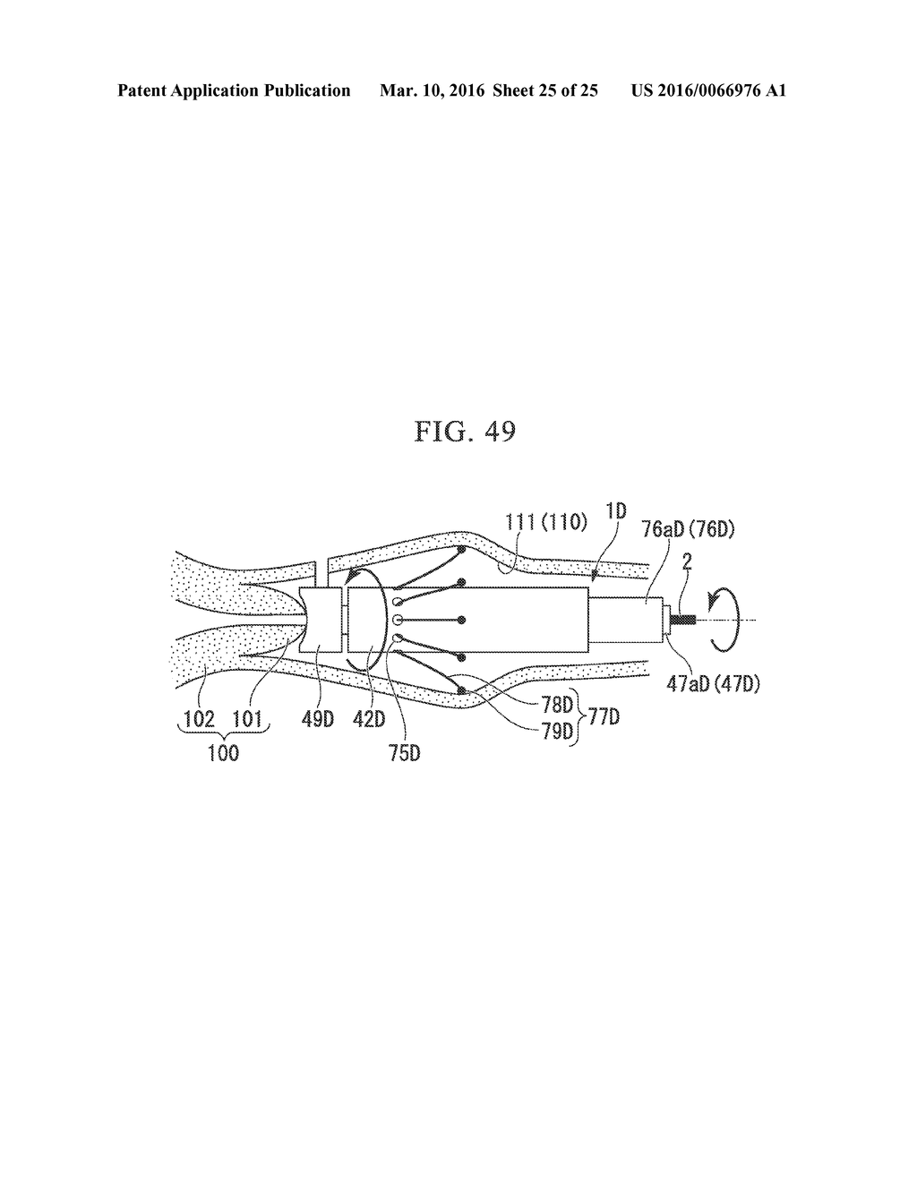 INCISION INSTRUMENT - diagram, schematic, and image 26