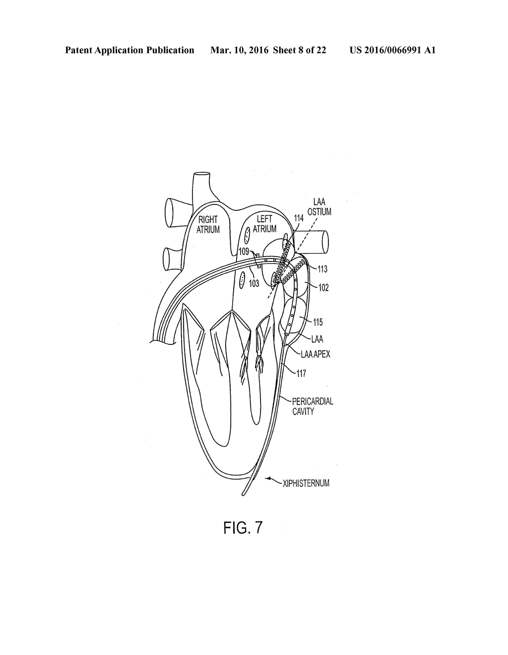 METHODS AND SYSTEMS FOR ACCESSING A PERICARDIAL SPACE AND PREVENTING     STROKES ARISING FROM THE LEFT ATRIAL APPENDAGE - diagram, schematic, and image 09