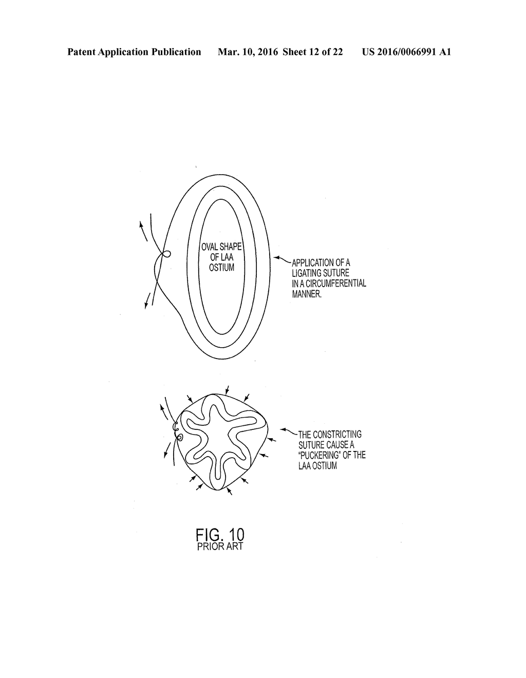 METHODS AND SYSTEMS FOR ACCESSING A PERICARDIAL SPACE AND PREVENTING     STROKES ARISING FROM THE LEFT ATRIAL APPENDAGE - diagram, schematic, and image 13