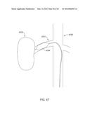 METHODS AND APPARATUSES FOR REMODELING TISSUE OF OR ADJACENT TO A BODY     PASSAGE diagram and image