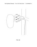 METHODS AND APPARATUSES FOR REMODELING TISSUE OF OR ADJACENT TO A BODY     PASSAGE diagram and image