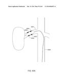 METHODS AND APPARATUSES FOR REMODELING TISSUE OF OR ADJACENT TO A BODY     PASSAGE diagram and image