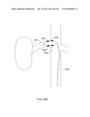 METHODS AND APPARATUSES FOR REMODELING TISSUE OF OR ADJACENT TO A BODY     PASSAGE diagram and image