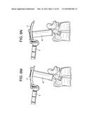 Proximal-End Securement of a Minimally Invasive Working Channel diagram and image