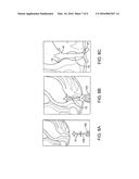 Fecal Incontinence Device, System And Method diagram and image