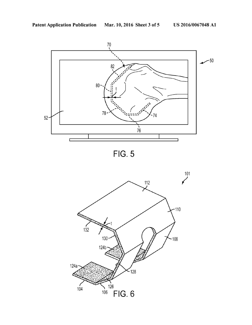 IMPLANT WITH PATIENT-SPECIFIC POROUS STRUCTURE - diagram, schematic, and image 04