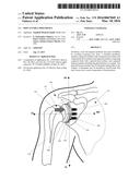 IMPLANTABLE PROSTHESES diagram and image