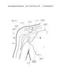 IMPLANTABLE PROSTHESES diagram and image