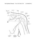 IMPLANTABLE PROSTHESES diagram and image