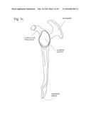 IMPLANTABLE PROSTHESES diagram and image