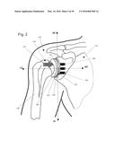 IMPLANTABLE PROSTHESES diagram and image