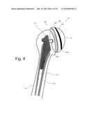 IMPLANTABLE PROSTHESES diagram and image