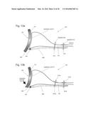 IMPLANTABLE PROSTHESES diagram and image