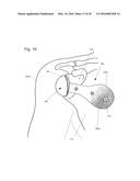 IMPLANTABLE PROSTHESES diagram and image