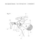 IMPLANTABLE PROSTHESES diagram and image