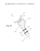 IMPLANTABLE PROSTHESES diagram and image