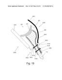 IMPLANTABLE PROSTHESES diagram and image