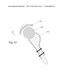 IMPLANTABLE PROSTHESES diagram and image