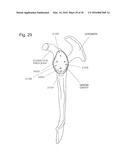 IMPLANTABLE PROSTHESES diagram and image