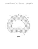 SPINAL IMPLANT SYSTEM AND METHOD diagram and image