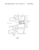 SPINAL IMPLANT SYSTEM AND METHOD diagram and image