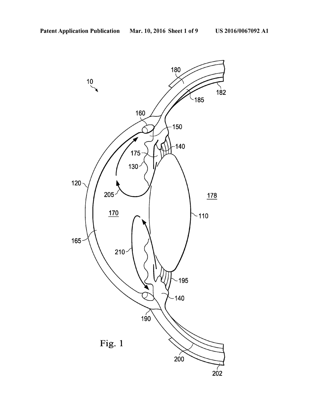 INTRAOCULAR PRESSURE SENSING SYSTEM FOR POSTERIOR SEGMENT DRAINAGE - diagram, schematic, and image 02