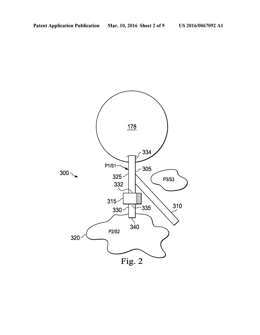 INTRAOCULAR PRESSURE SENSING SYSTEM FOR POSTERIOR SEGMENT DRAINAGE - diagram, schematic, and image 03