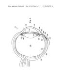 INTRAOCULAR PRESSURE SENSING SYSTEM FOR POSTERIOR SEGMENT DRAINAGE diagram and image