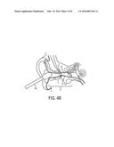 AURAL FOREIGN BODY REMOVAL DEVICE AND RELATED METHODS OF USE AND     MANUFACTURE diagram and image