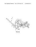 AURAL FOREIGN BODY REMOVAL DEVICE AND RELATED METHODS OF USE AND     MANUFACTURE diagram and image