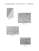 SYSTEM FOR PERCUTANEOUSLY ADMINISTERING REDUCED PRESSURE TREATMENT USING     BALLOON DISSECTION diagram and image