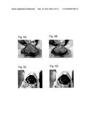 ADHESION PREVENTING AGENT diagram and image