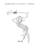 Clearance of Sinus Ostia Blockage diagram and image