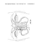 Clearance of Sinus Ostia Blockage diagram and image