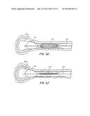 Clearance of Sinus Ostia Blockage diagram and image