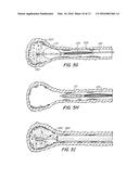 Clearance of Sinus Ostia Blockage diagram and image