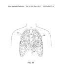 RECEPTACLE FOR PACEMAKER LEAD diagram and image