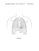 RECEPTACLE FOR PACEMAKER LEAD diagram and image