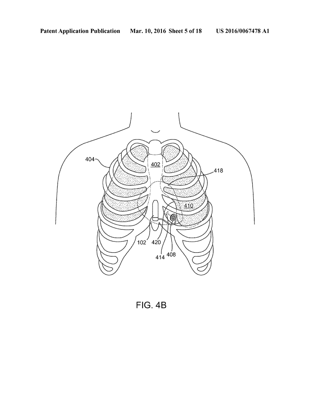 RECEPTACLE FOR PACEMAKER LEAD - diagram, schematic, and image 06