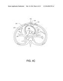 RECEPTACLE FOR PACEMAKER LEAD diagram and image