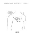 FAR-FIELD R-WAVE DETECTION TO CONTROL ATRIAL PACE TIMING IN A DUAL-CHAMBER     LEADLESS PACEMAKER diagram and image