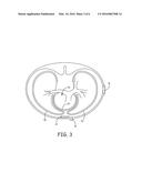 MULTIPLE TRANSFORMER CHARGING CIRCUITS FOR IMPLANTABLE MEDICAL DEVICES diagram and image