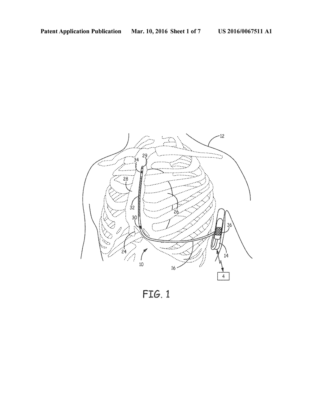 TRANSTHORACIC PROTECTION CIRCUIT FOR IMPLANTABLE MEDICAL DEVICES - diagram, schematic, and image 02