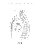 TRANSTHORACIC PROTECTION CIRCUIT FOR IMPLANTABLE MEDICAL DEVICES diagram and image