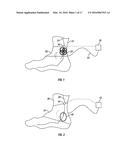 METHOD AND APPARATUS FOR ELECTRICAL STIMULATION THERAPY diagram and image